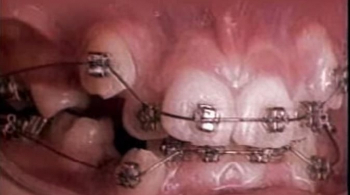 Sorprendente vídeo de cómo se juntan los dientes en 20 segundos